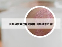 自癜风恢复过程的图片 自癜风怎么治?