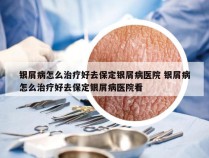 银屑病怎么治疗好去保定银屑病医院 银屑病怎么治疗好去保定银屑病医院看