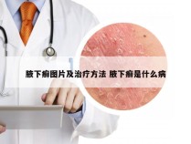 腋下癣图片及治疗方法 腋下癣是什么病