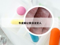 牛皮癣让我没法见人