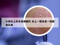 小孩头上长头皮癣图片 头上一层白皮一抠就变头屑