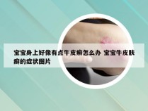 宝宝身上好像有点牛皮癣怎么办 宝宝牛皮肤癣的症状图片