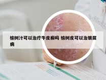 榆树汁可以治疗牛皮癣吗 榆树皮可以治银屑病