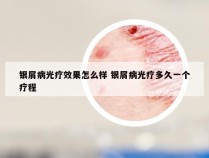 银屑病光疗效果怎么样 银屑病光疗多久一个疗程