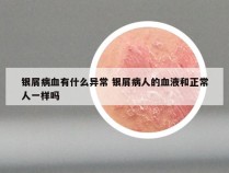 银屑病血有什么异常 银屑病人的血液和正常人一样吗