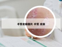 手臂皮癣图片 手臂 皮藓