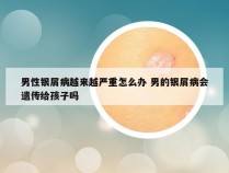 男性银屑病越来越严重怎么办 男的银屑病会遗传给孩子吗