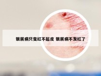 银屑病只变红不起皮 银屑病不发红了