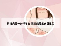 银销病是什么样子的 银消病是怎么引起的