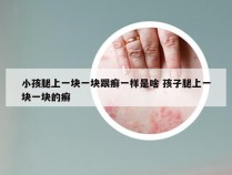 小孩腿上一块一块跟癣一样是啥 孩子腿上一块一块的癣