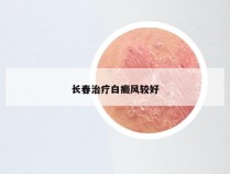 长春治疗白癜风较好