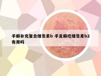 手癣补充复合维生素b 手足癣吃维生素b2有用吗