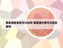 银屑病葱姜蒜可以吃吗 银屑病炒菜可以放葱姜吗