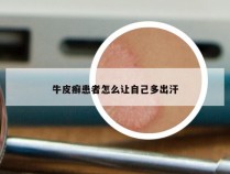 牛皮癣患者怎么让自己多出汗