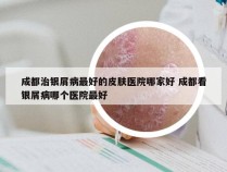 成都治银屑病最好的皮肤医院哪家好 成都看银屑病哪个医院最好