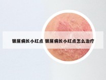 银屑病长小红点 银屑病长小红点怎么治疗