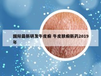 国际最新研发牛皮癣 牛皮肤癣新药2019年