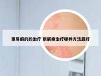 银屑癣的的治疗 银屑癣治疗哪种方法最好