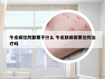 牛皮癣住院都要干什么 牛皮肤癣需要住院治疗吗