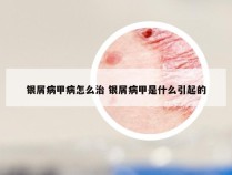 银屑病甲病怎么治 银屑病甲是什么引起的