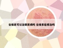 谷维素可以治银屑病吗 谷维素能根治吗