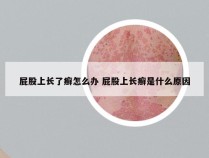 屁股上长了癣怎么办 屁股上长癣是什么原因