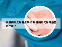 银屑病照光后有点发红 银屑病照光后痒感觉更严重了