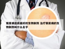 银屑病目前最好的生物制剂 治疗银屑病的生物制剂叫什么名字