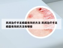 民间治疗手足癣最有效的方法 民间治疗手足癣最有效的方法有哪些