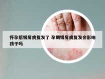 怀孕后银屑病复发了 孕期银屑病复发会影响孩子吗