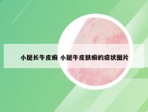 小腿长牛皮癣 小腿牛皮肤癣的症状图片