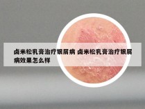 卤米松乳膏治疗银屑病 卤米松乳膏治疗银屑病效果怎么样