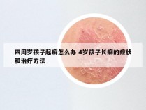 四周岁孩子起癣怎么办 4岁孩子长癣的症状和治疗方法