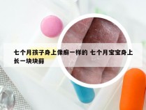 七个月孩子身上像癣一样的 七个月宝宝身上长一块块藓