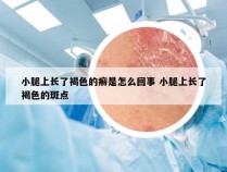 小腿上长了褐色的癣是怎么回事 小腿上长了褐色的斑点