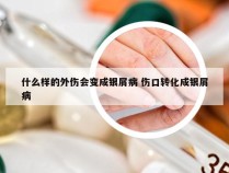 什么样的外伤会变成银屑病 伤口转化成银屑病