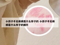 小孩子手足癣病是什么样子的 小孩子手足癣病是什么样子的图片