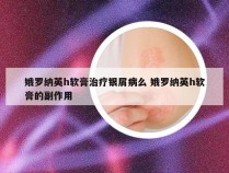 娥罗纳英h软膏治疗银屑病么 娥罗纳英h软膏的副作用