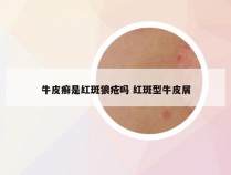 牛皮癣是红斑狼疮吗 红斑型牛皮屑