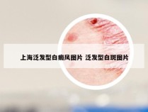 上海泛发型白癜风图片 泛发型白斑图片