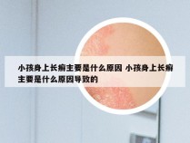 小孩身上长癣主要是什么原因 小孩身上长癣主要是什么原因导致的