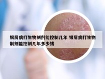 银屑病打生物制剂能控制几年 银屑病打生物制剂能控制几年多少钱