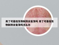 用了可善挺生物制剂会复发吗 用了可善挺生物制剂会复发吗怎么办