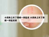 小孩身上长了像癣一样起皮 小孩身上长了像癣一样起皮屑