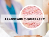 手上长癣用什么最好 手上长癣用什么最好使