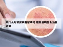 喝什么对银屑病有帮助吗 银屑病喝什么汤有效果