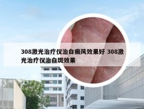 308激光治疗仪治白癜风效果好 308激光治疗仪治白斑效果