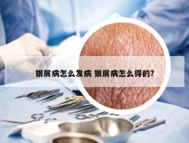 银屑病怎么发病 银屑病怎么得的?