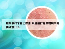 银屑病打了肾上腺素 银屑病打完生物制剂需要注意什么