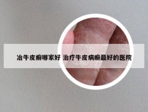 冶牛皮癣哪家好 治疗牛皮病癣最好的医院